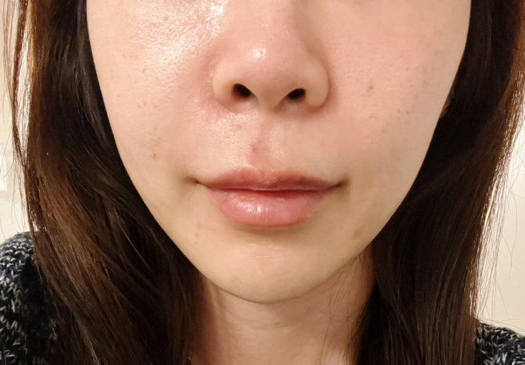  신사역 피부과 땅콩형얼굴 심부볼 윤곽주사 제로팻 1차시술 솔직후기