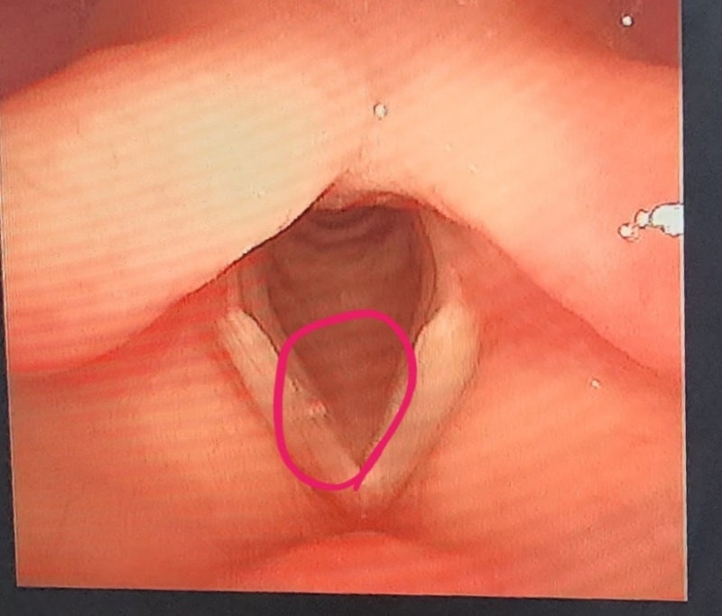 성대폴립? 자연치유 가능할까?