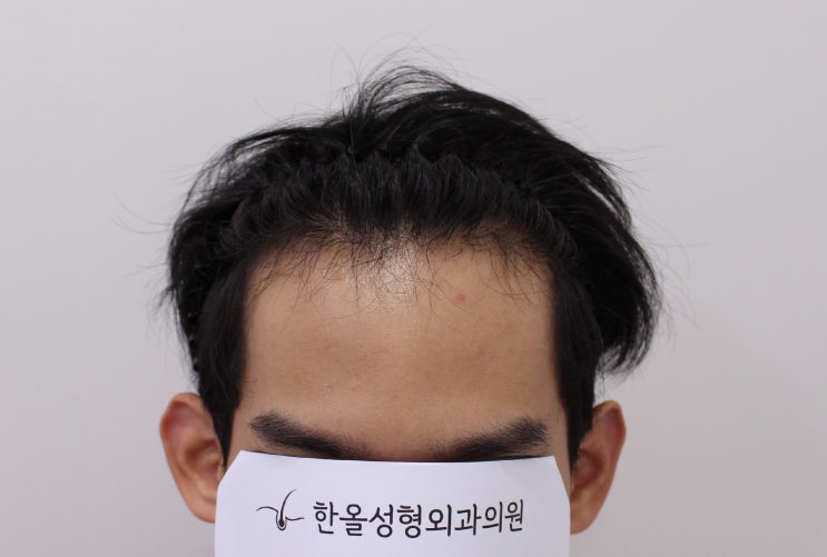  20대 남성 헤어라인 비절개 2500모 2주 경과
