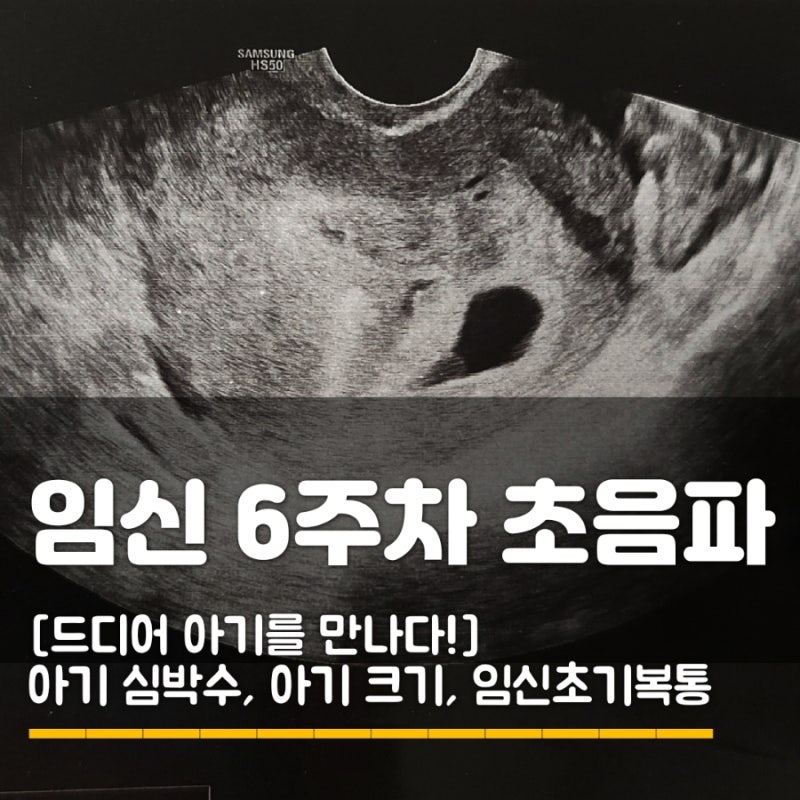 임신 6주차 초음파 검사 후기 심장음 성별궁전 메스꺼움 약 처방