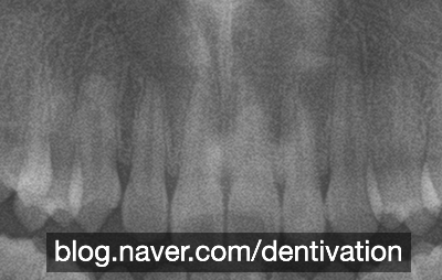 교정치료 하면 치아 뿌리가 짧아지나요? 치아교정과 치근