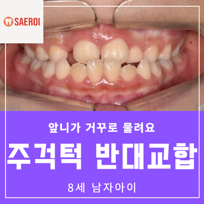  앞니가 거꾸로 물리는 주걱턱 반대교합 / 8세 남자아이