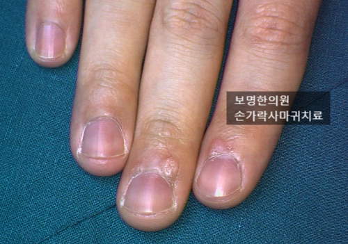손가락티눈 마디마다 생겼는데 안 없어지네요