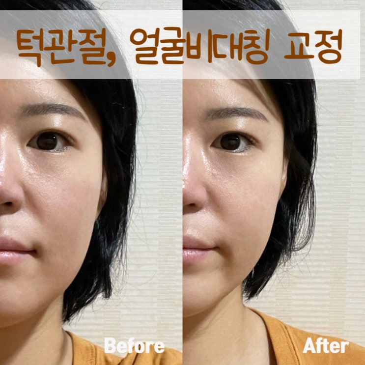  강남 얼굴비대칭 교정 - 규인미체형맞춤운에서 턱관절 & 비대칭 교정