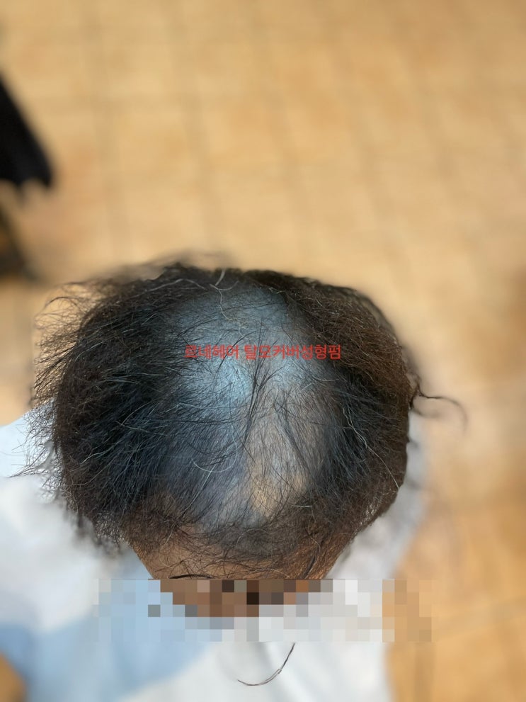  두피문신실패 탈모펌금융치료후/ 부산사상 르네시떼 6층미용실 남구해운대구중구북구영도구사상구사하구기장군김해시진구금정구수영구경남