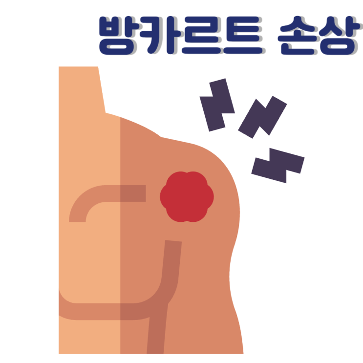  방카르트 손상 증상과 어깨 탈구 수술 후 재활에 대해 알아보기