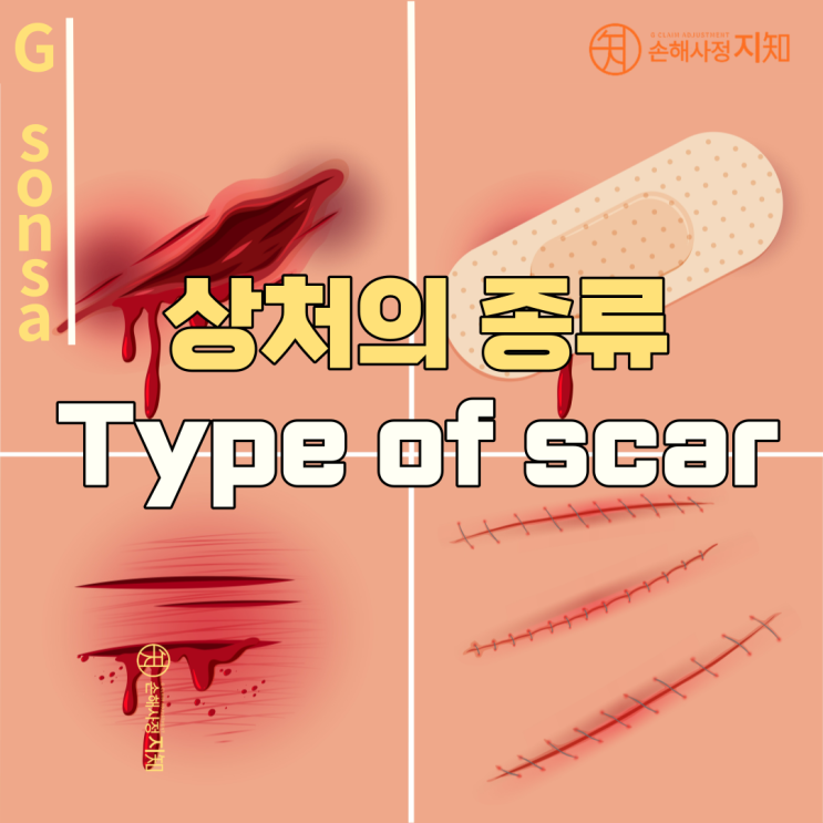  [의학소식] 열상과 자상, 상처의 종
