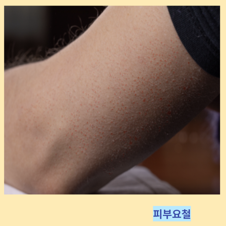 몸 얼굴 피부요철 원인 및 요철없애는법 정리 몸 얼굴 피부요철 원인 및 요철없애는법 정리