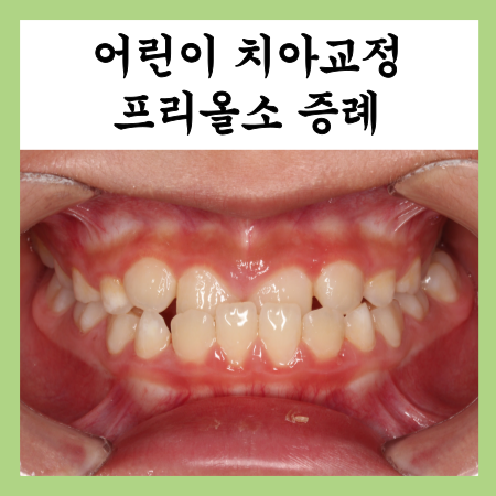  노원 어린이교정, 부정교합 개선 전후 비교 (프리올소)