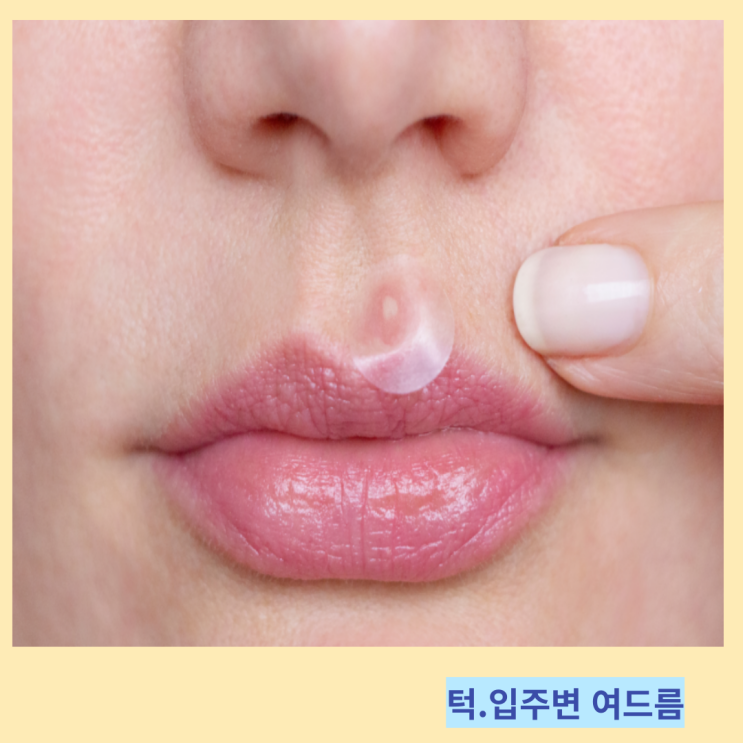 턱밑 입술 입주변 여드름 원인 및 관리 방법 턱밑 입술 입주변 여드름 원인 및 관리 방법