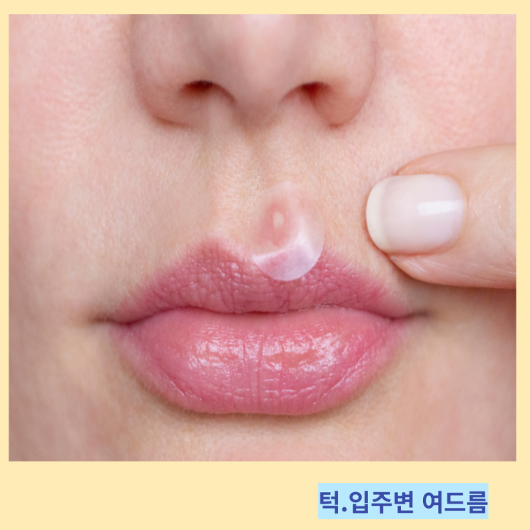 턱밑 입술 입주변 여드름 원인 및 관리 방법