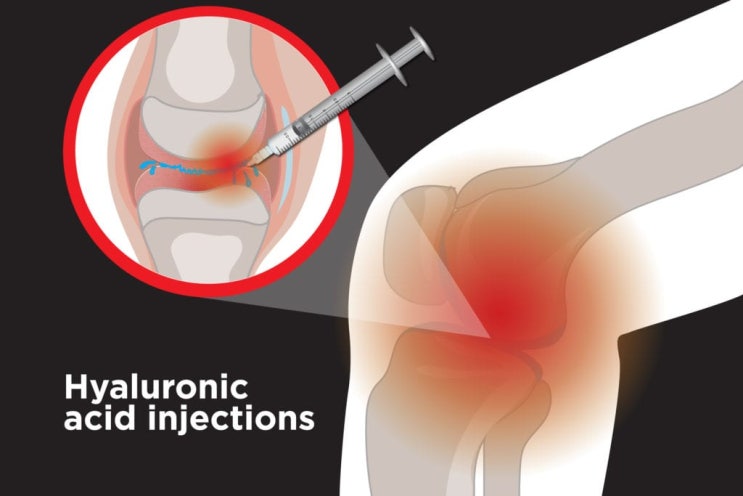 하지 통증, 무릎 퇴행성 관절염 (2)