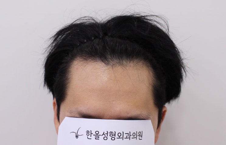  30대 남성 헤어라인 비절개 2500모 2주 경과