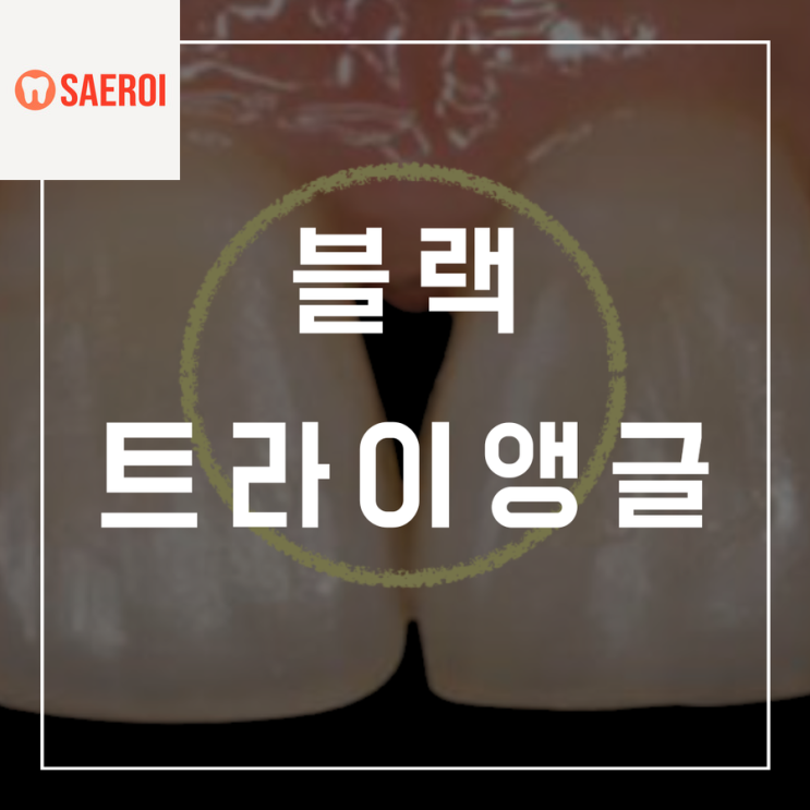  치아교정 후 블랙트라이앵글은 왜 생길까? 없애는 방법과 블트의 모든 것!!