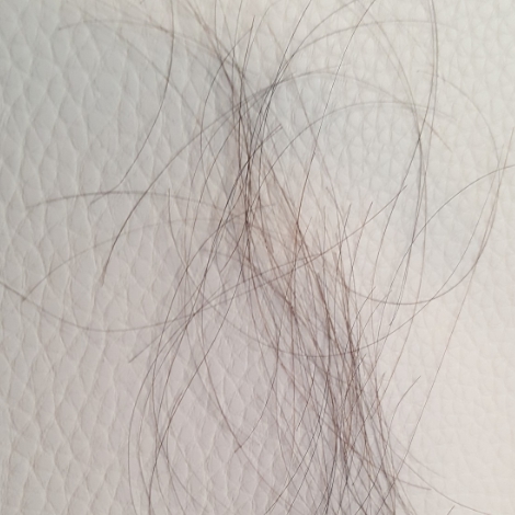 여성<b>탈모</b> 원인과 <b>탈모치료제</b> 대체로 영양제 섭취하기! <b>효과</b>는?