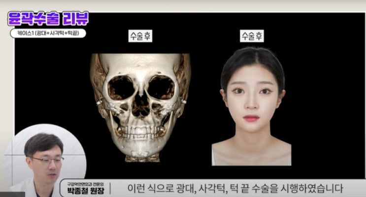  윤곽수술시 뼈절제와 연조직변화양상 3d 분석