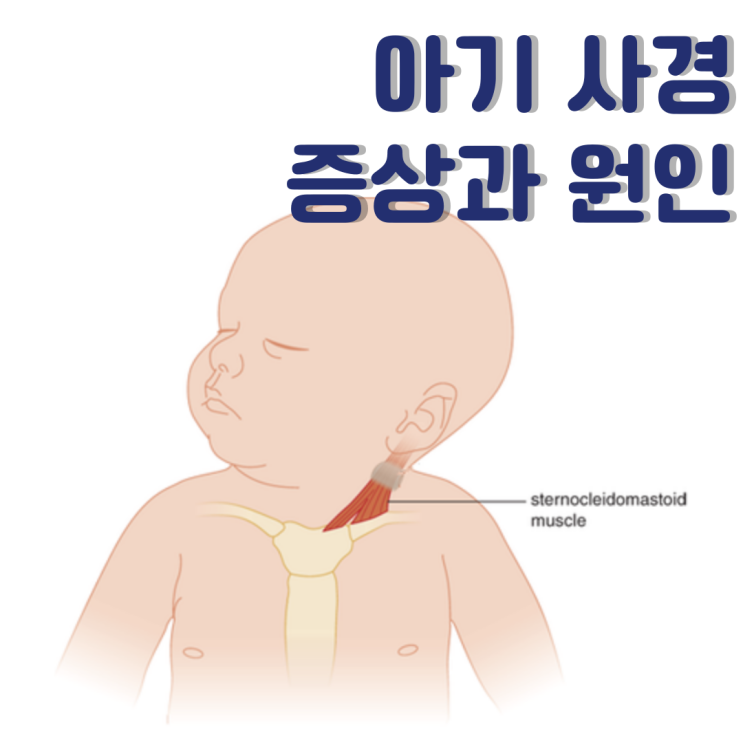  아기 사경 증상과 원인 흉쇄유돌근과의 관계 알아보기