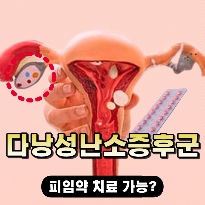 다낭성난소증후군 피임약 복용하면 생리불순 치료할수 있나요
