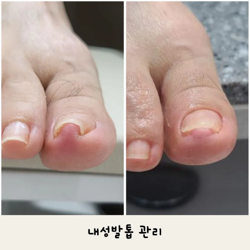대전 내성발톱/파고드는발톱 병원에서수술상담받고 뮬랑네일소개받고오신후기