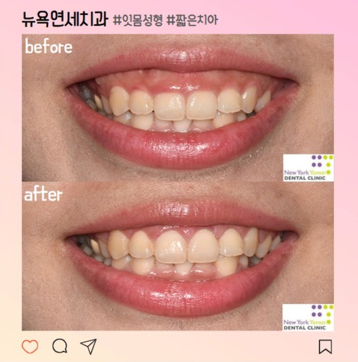  웃을 때 짧은 치아, 잇몸 성형으로 해결 (a.k.a. 강남 잇몸성형전문치과)