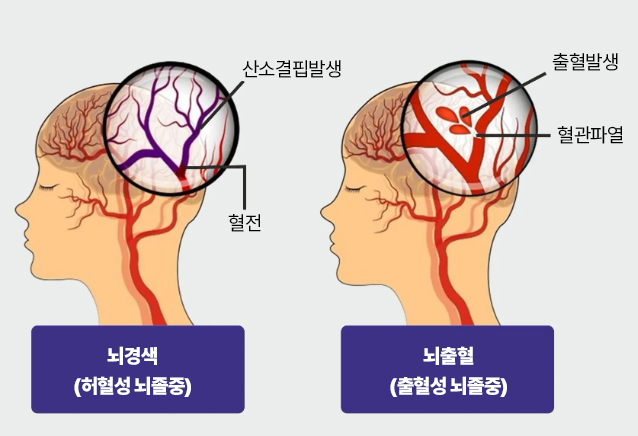  겨울철 악마, 침묵의 저격수 '뇌졸중'의 또 다른 이름
