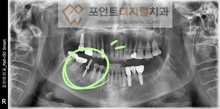  [탕정치과] 치아파절로 발치(발치즉시 임플란트) / 천안 아산