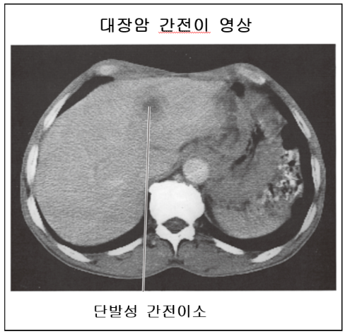 결장 직장암 간, 증상 및 관리 방법 세 가지? 3