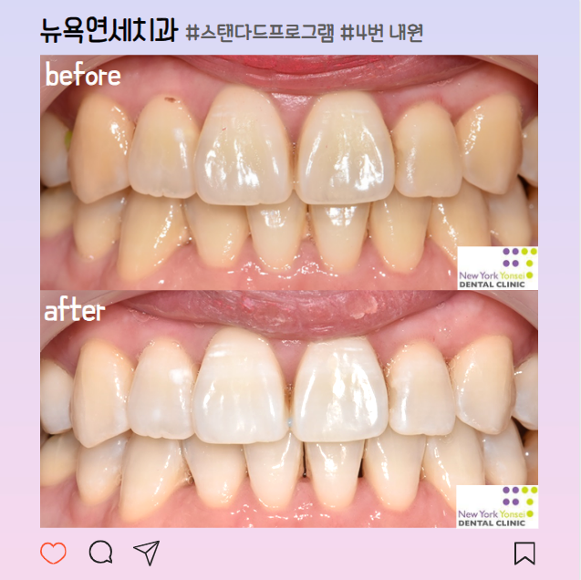 강남역치아미백 치과 비용 및 효과 후기