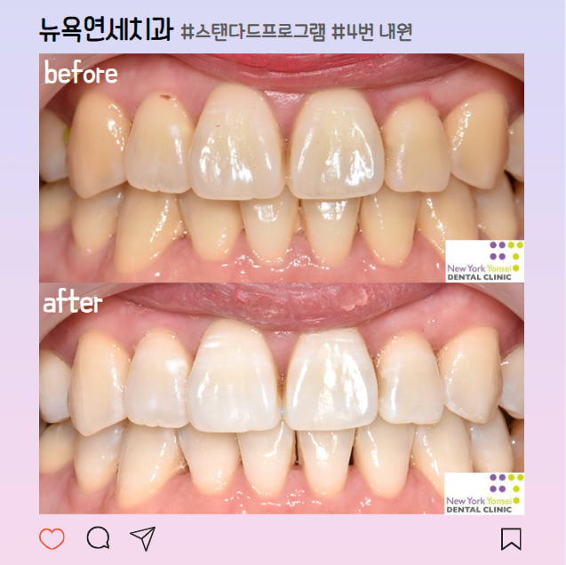  강남역치아미백 치과 비용 및 효과 후기