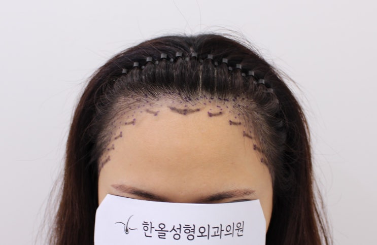  30대 여성 비절개 헤어라인 3000모 2주 경과