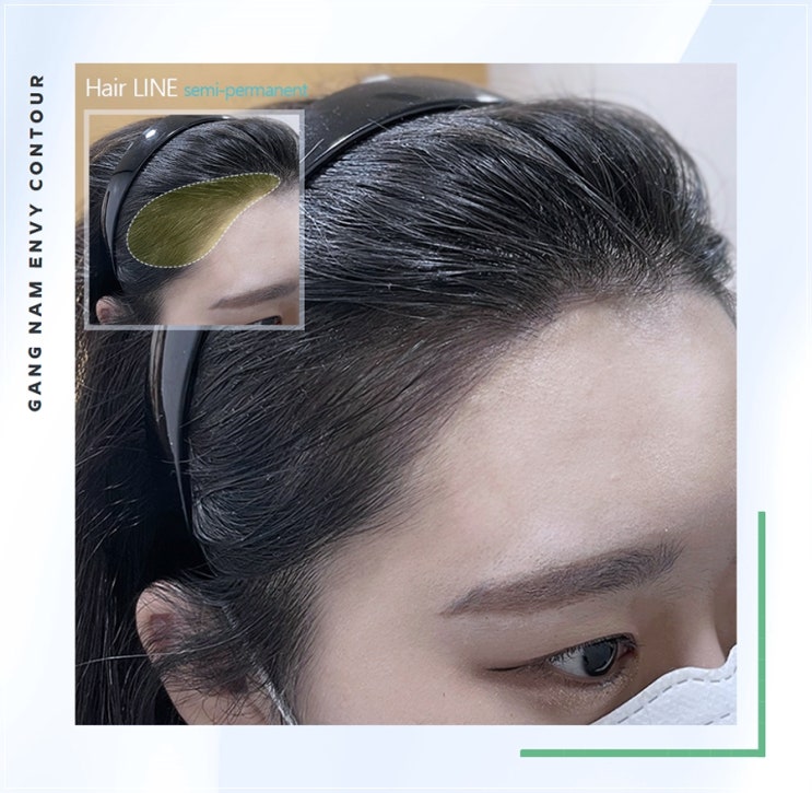  여성탈모 두피문신 어떠한 과정으로 진행 될까