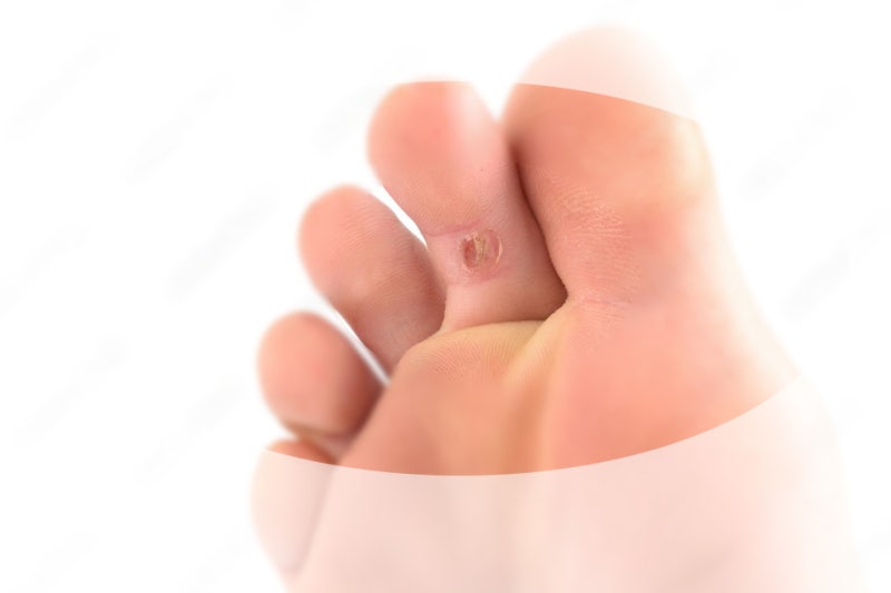 어린이 티눈 아기 무좀 원인 증상 치료방법