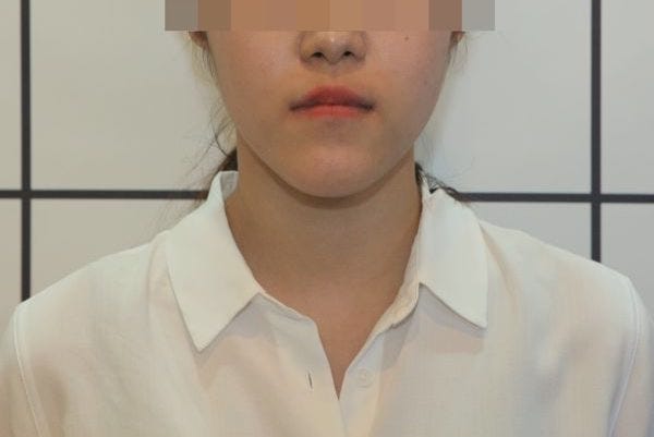  앞으로 나온 아래턱에 대해 고민이 있으신가요? 주걱턱 교정치료