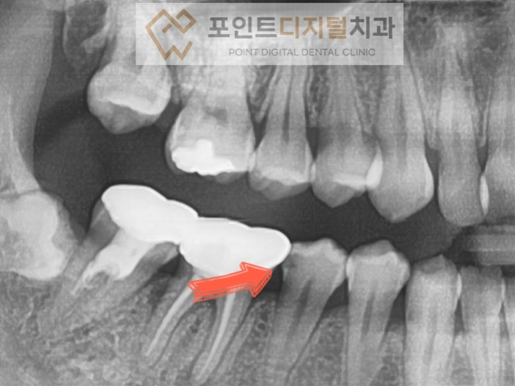  [탕정치과] 충치치료(세라믹 하이브리드 인레이) / 천안 아산