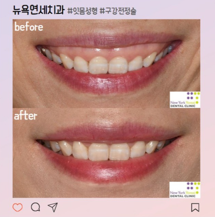  구강전정술로 잇몸 보임 해결