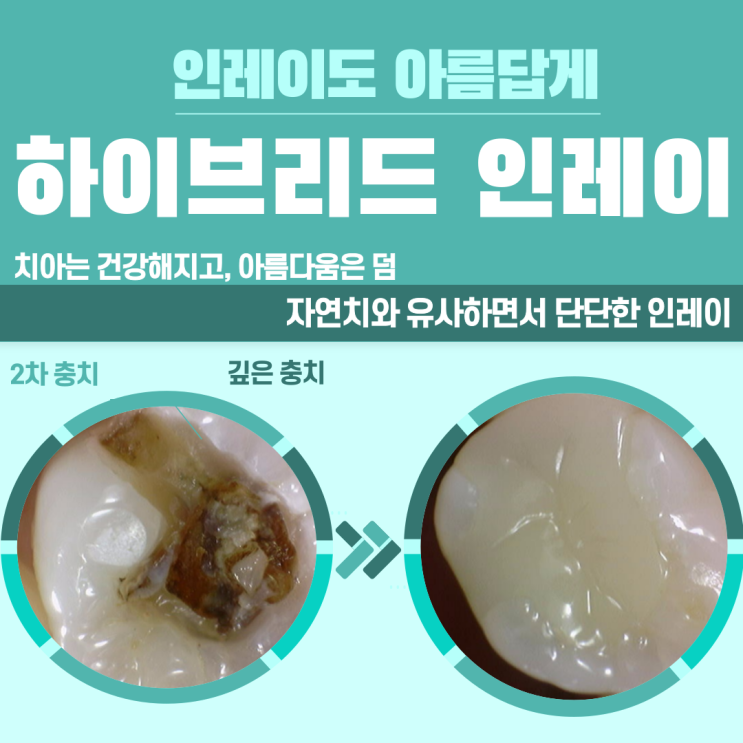  인레이치료3