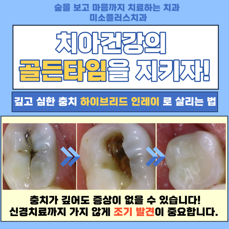  인레이5