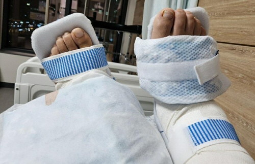 실화탐사대 왼발 수술 해 달랬는데 오른발 수술 영구장애 발목 관절 유합술 역대급 의료사고 정형외과 병원 어디 실화탐사대 왼발 수술 해 달랬는데 오른발 수술 영구장애 발목 관절 유합술 역대급 의료사고 정형외과 병원 어디