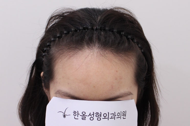  20대 여성 헤어라인 절개 3000모 2주 경과
