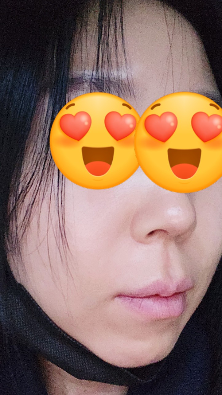  팔자주름 필러 내돈내산 찐후기 (가격, 통증) / 점심으로 미사국수 우동집