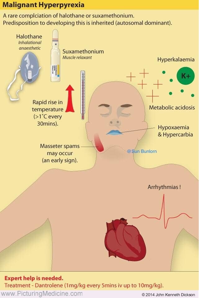희귀질환 _ 악성고열증 (Malignant Hyperthermia) : 네이버 블로그