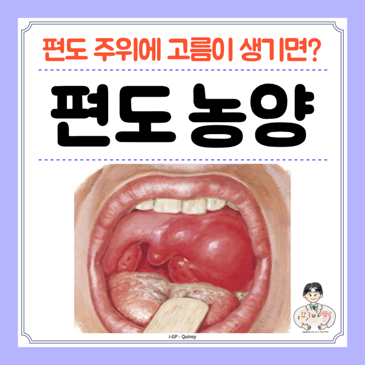  편도 주위 농양, 고름(peritonsillar abscess), 원인 증상 제거 수술