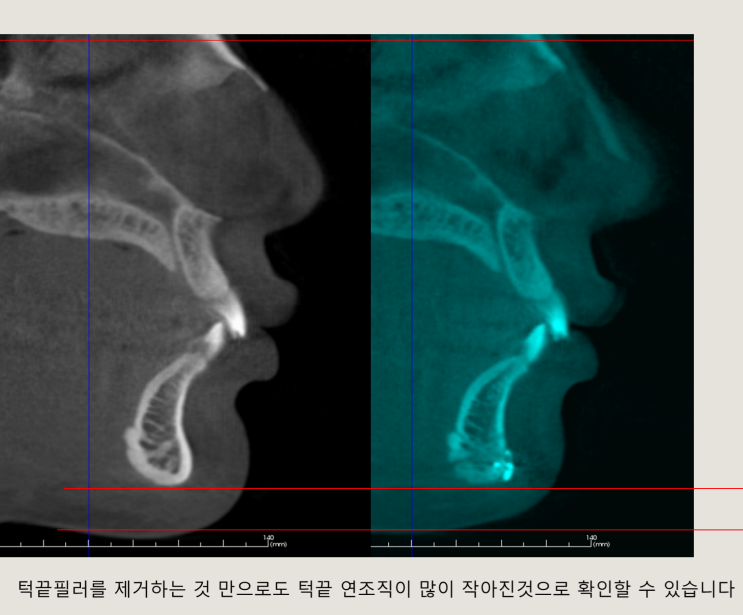  filler가 얼굴을 얼마나 길어지게 할까요?