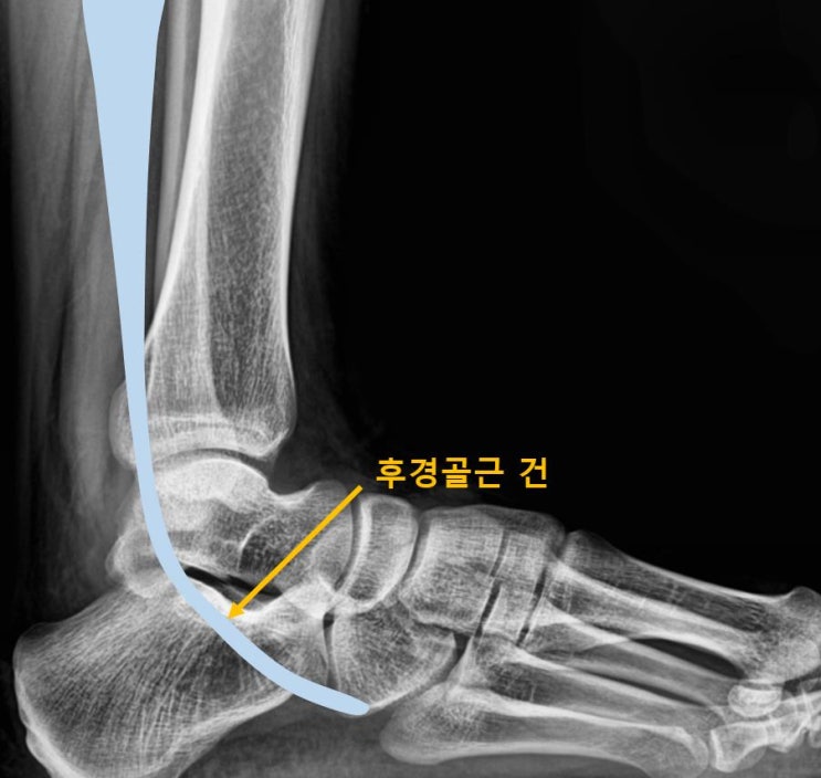  광주 정형외과 추천, 족부 발목 문제 차도가 없다면 필독