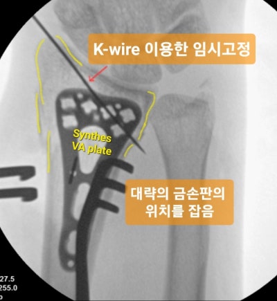원위요골골절 (Distal radius fracture)의 수술 시기 : 부기가 생기기 전에 빠른 수술, 좋은 결과 : 네이버 블로그