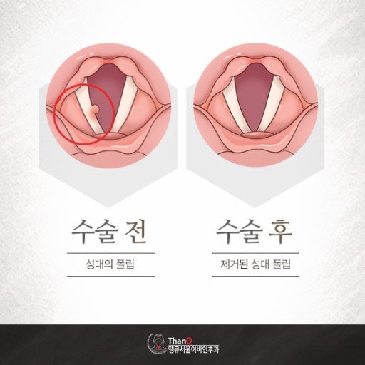 성대결절 성대폴립 제거 수술 후기 (후두미세수술)