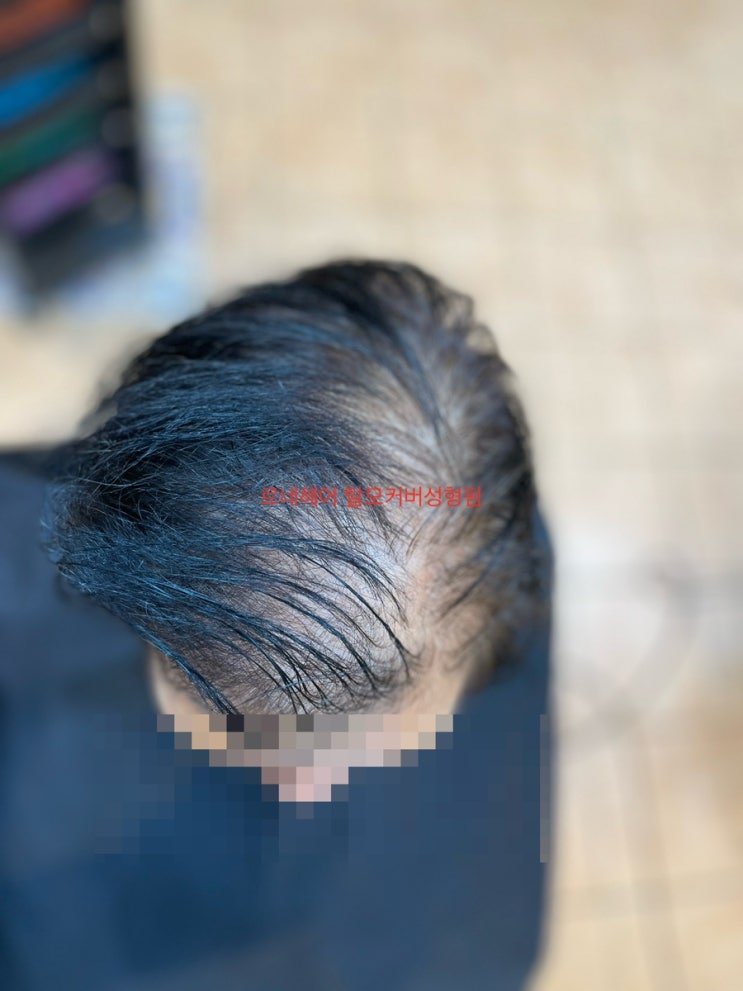  심한여자탈모펌시술후 부산 사상탈모클리닉전문 르네시떼미용실/ 감전모라덕천화명명지대저대동용원녹산김해울산양산남해진주창원밀양하동경주해운대광안리수영망미안락남천남포초량연제감만용원영도충렬서면