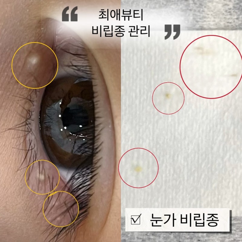 천안 쌍용동 눈가 비립종, 초등학생도 가능한 비립종 제거! 쥐젖, 편평사마귀 무제한으로 깔....