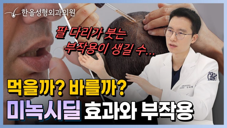  [한올성형외과] 탈모치료제 미녹시딜! 바를까? 먹을까? 미녹시딜 효과와 부작용