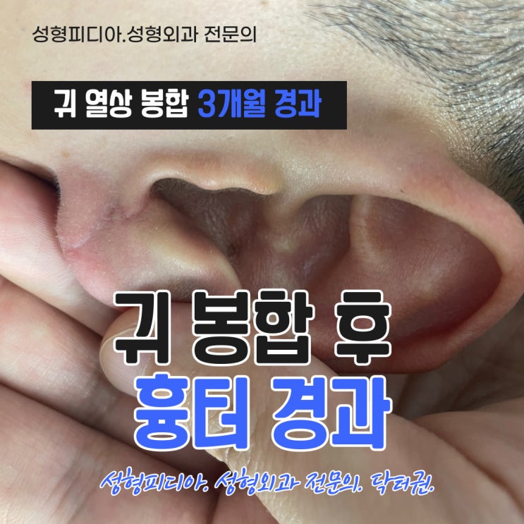[열상] 귀 열상 봉합 후 3개월 흉텨 경과 (귀 상처 흉터, 귀연골, feat. 성형외과 전문의)